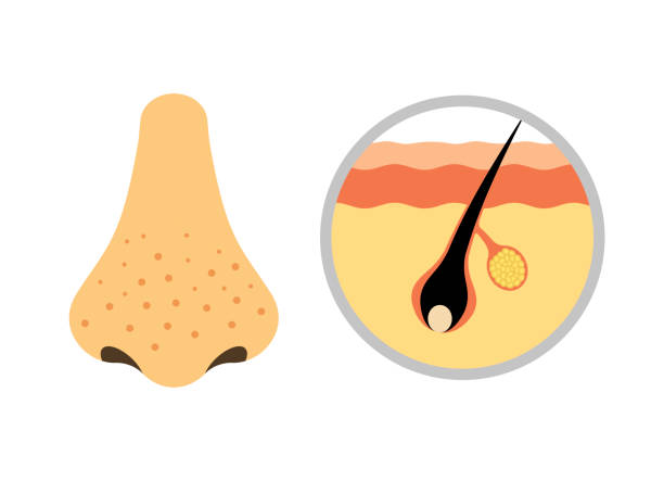 This image illustrates a human nose and a close-up view of a skin pore with a hair follicle. The left side shows