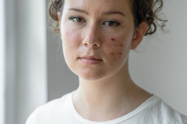 Portrait of a young woman with acne on her face looking thoughtful