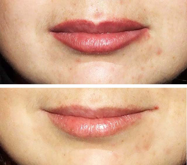 Lip Blushing Removal Guide: Options, Aftercare, and Expectations